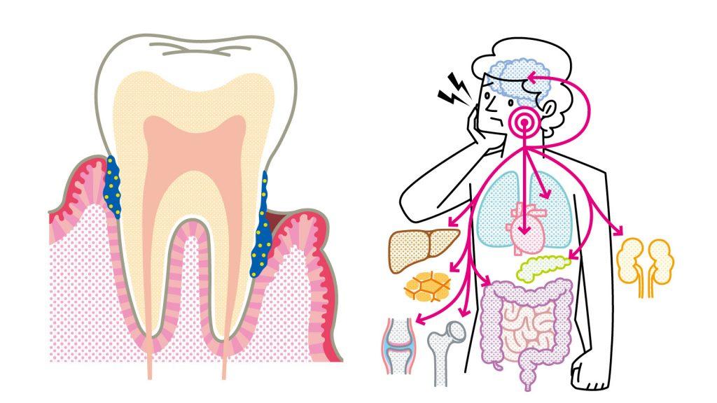 【加齢のトリセツ】大病を招きかねない歯周病の真実