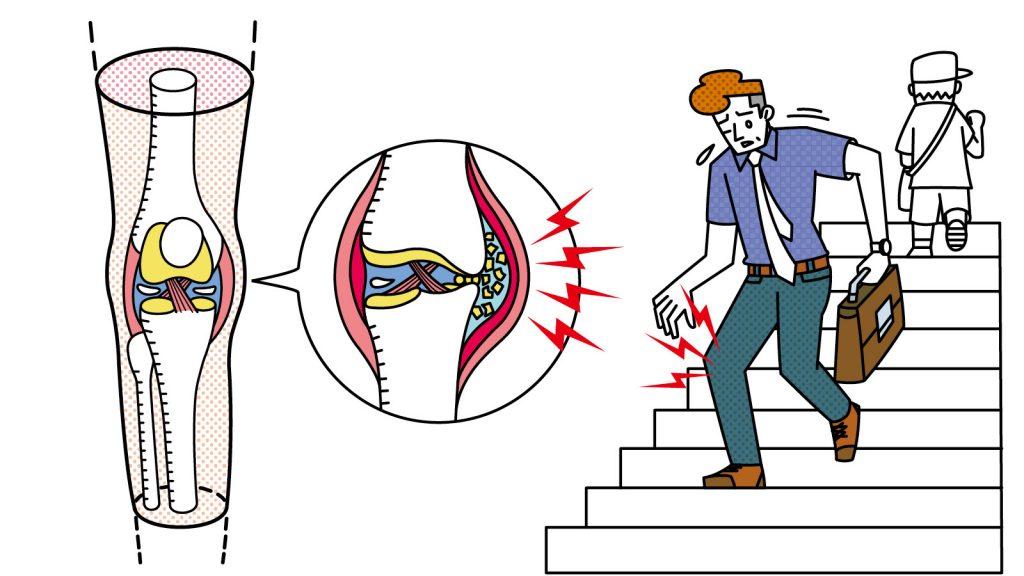 【加齢のトリセツ】膝に痛みや熱っぽさがある。それ「変形性膝関節症」かも