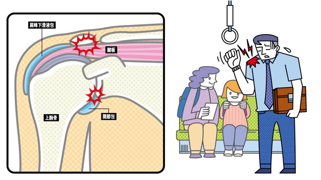 【加齢のトリセツ】四十肩・五十肩を放置してはいけない。別の疾患の可能性も