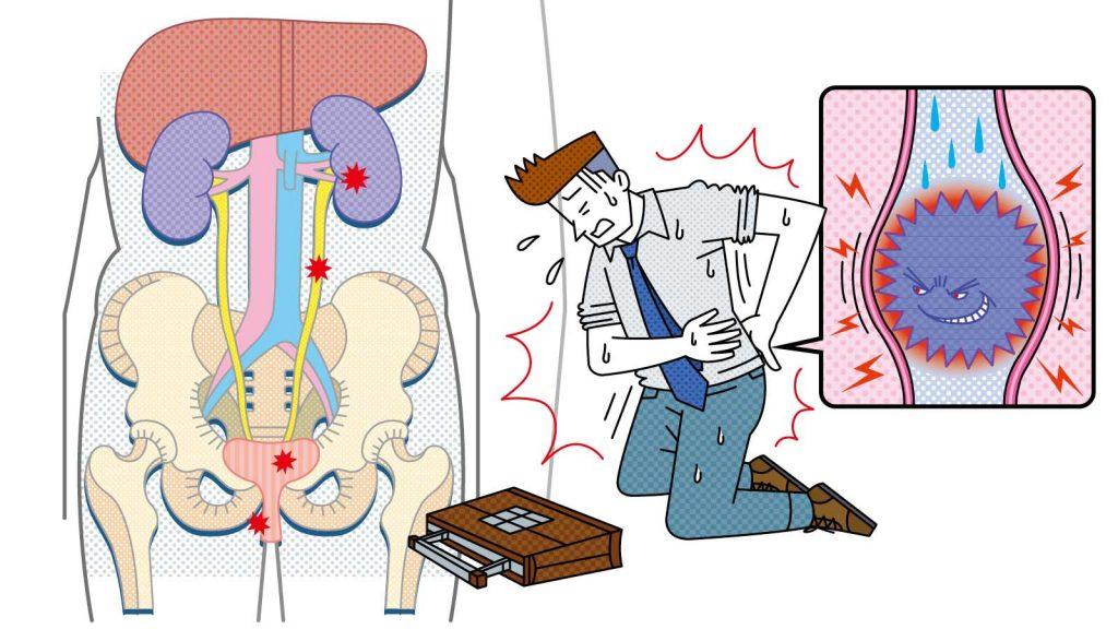 【加齢のトリセツ】ある日突然、人生最大級の痛みが！ 尿路結石は回復後も再発率が高い
