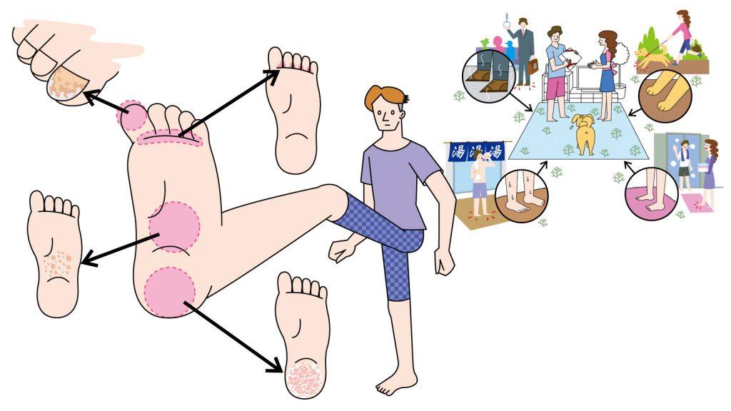 患者数は人類史上最大の感染症！ 水虫（白癬）の原因と対策