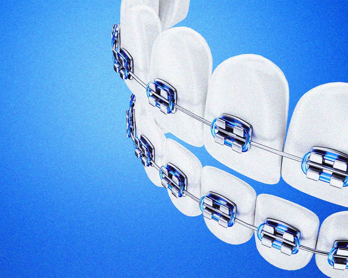 大人になって始める人も急増。歯の矯正にまつわる基本のQ&A。