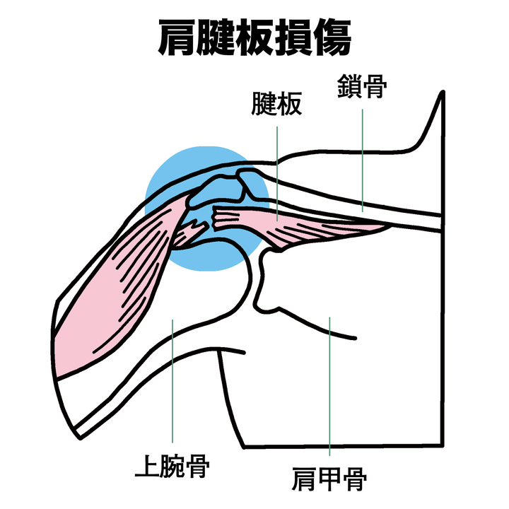 肩腱板損傷