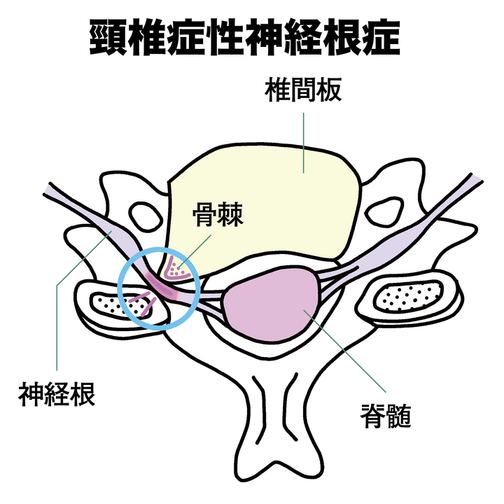 頸椎症性神経根症