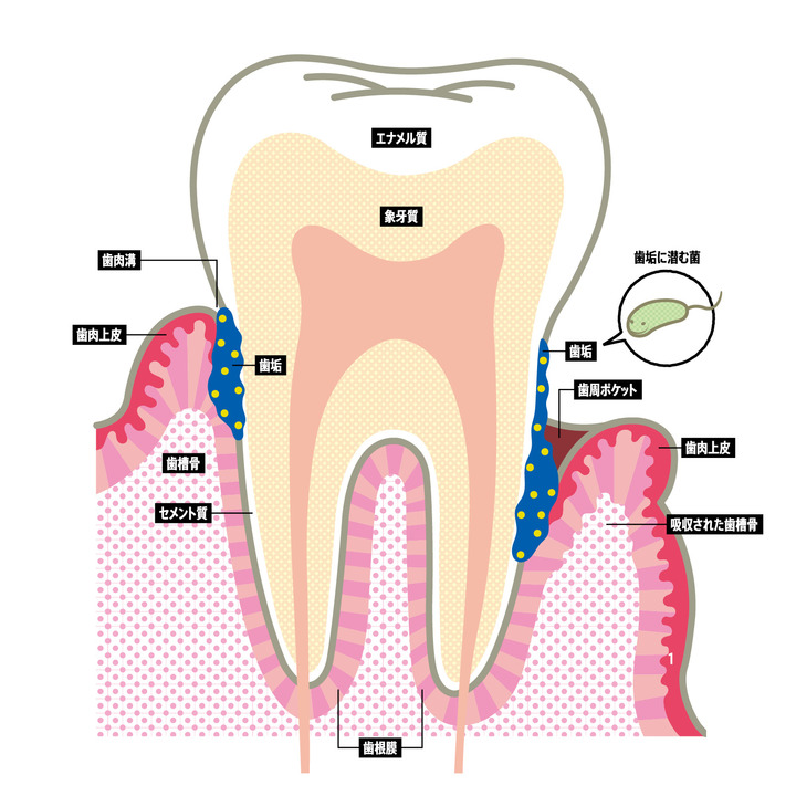 歯の健康な人も歯と歯肉の境目には歯肉溝を持つ。