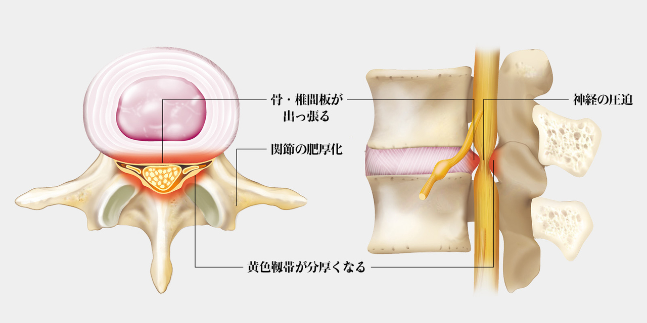 脊柱管狭窄症のメカニズム