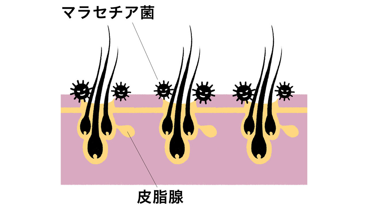 頭皮に存在するマラセチア菌の模式図（イラスト）