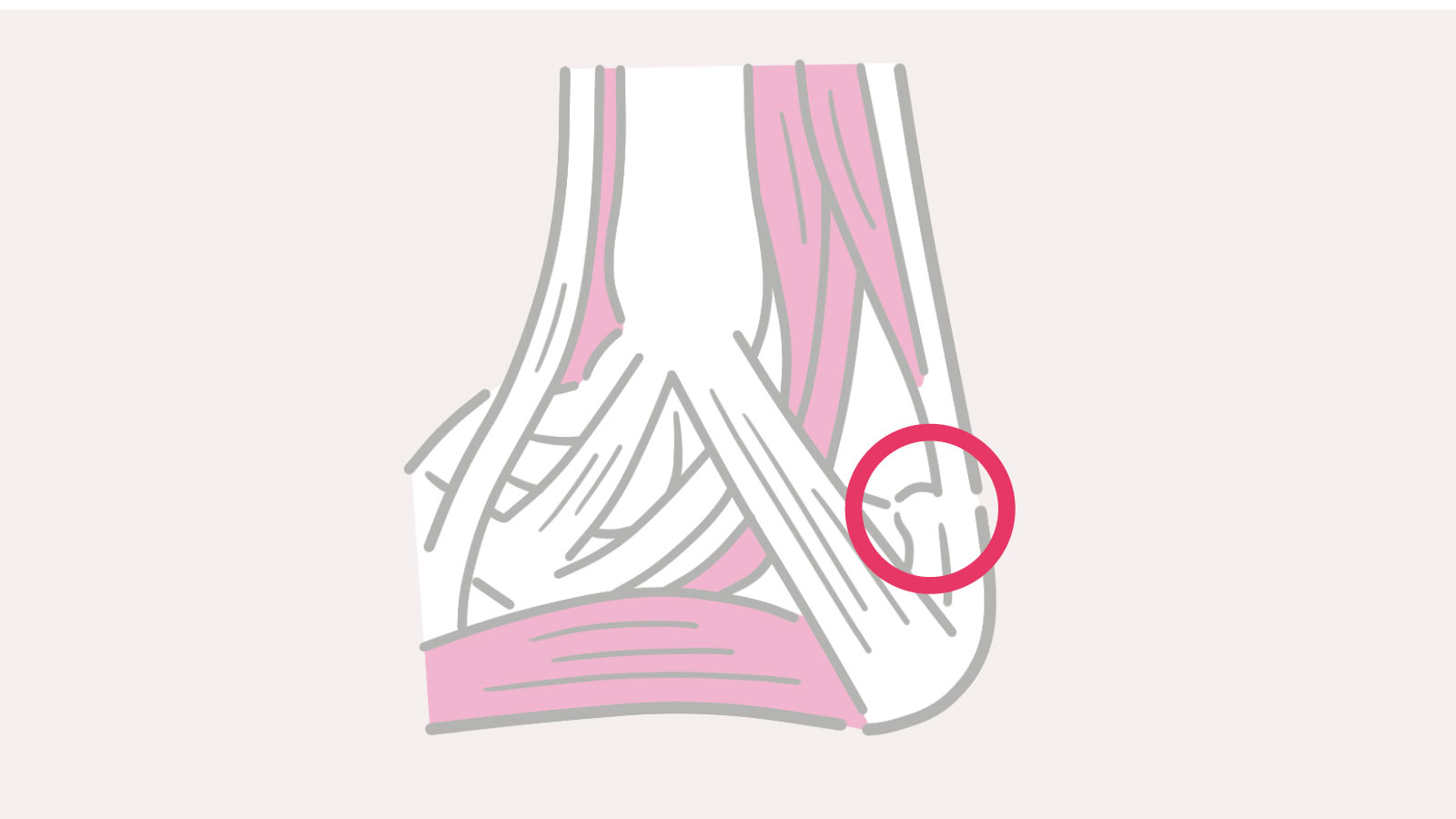 赤丸の踵骨付着部より約2cmの幅に起こる「アキレス腱付着部症」、その上に発症する「アキレス腱症」を説明するイラスト