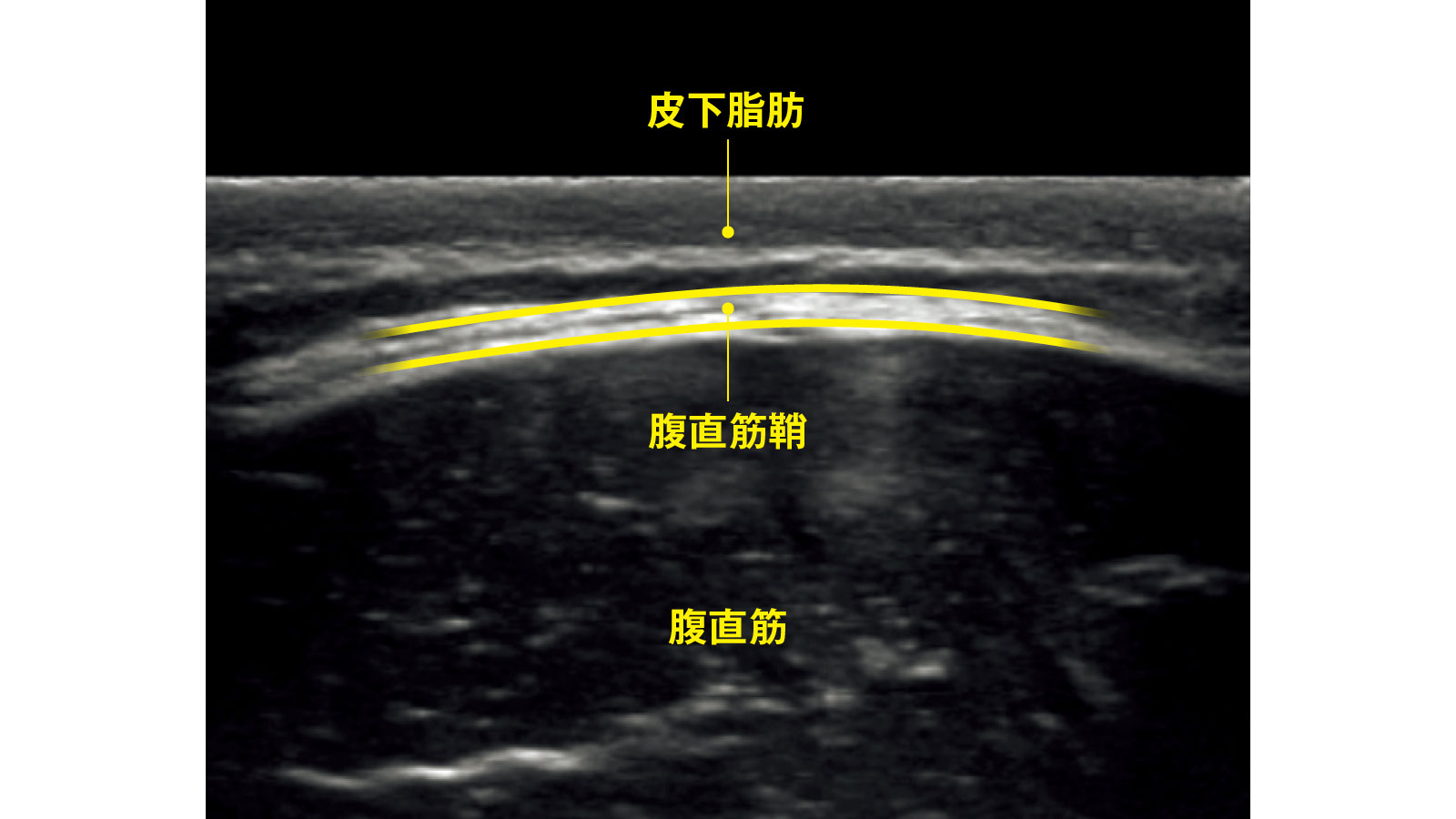 筋の上に筋膜、皮下脂肪の層がある 腹内部を横から見たときの超音波画像