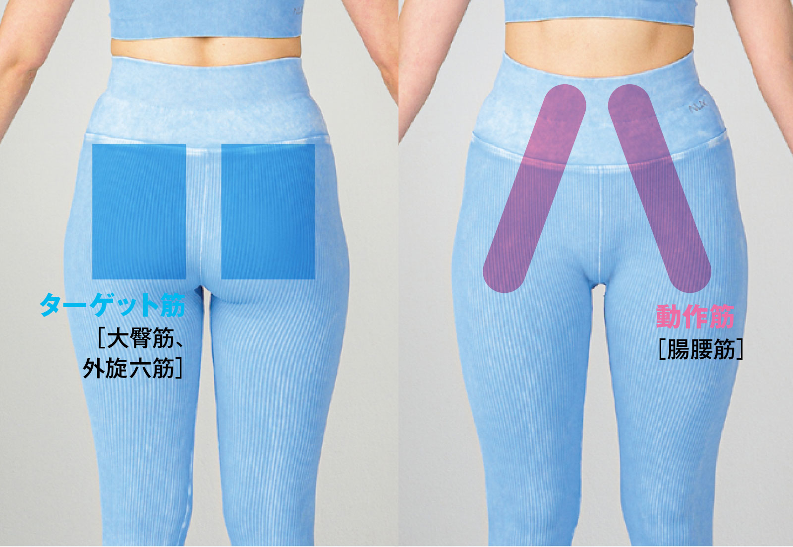 お尻の妊娠線を取り除く局所治療