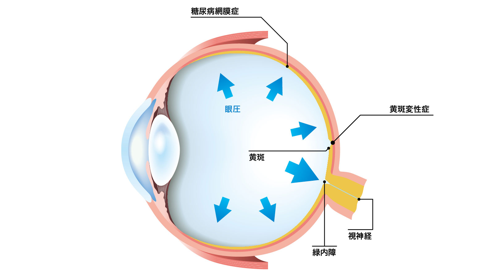 目の病気 図