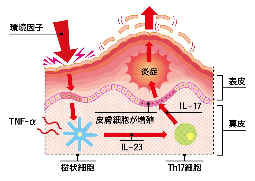 腸内細菌と乾癬の関係