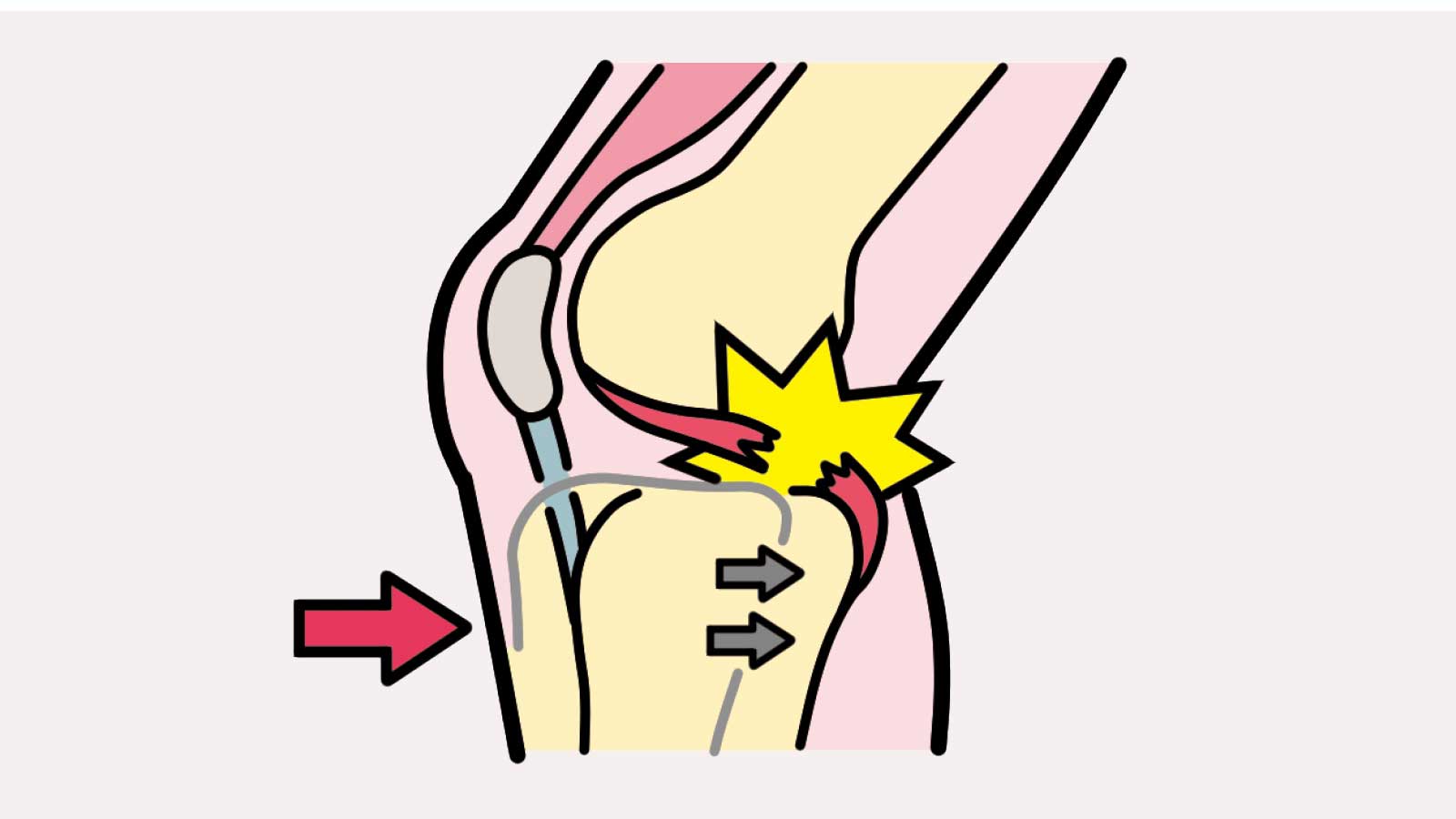 膝後十字靱帯（PCL）損傷