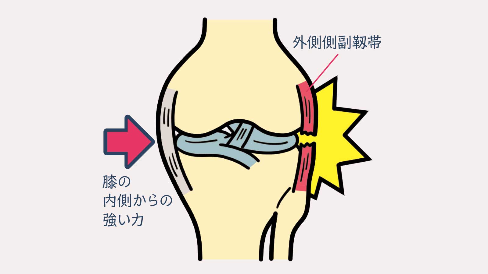 膝外側側副靱帯（LCL）損傷