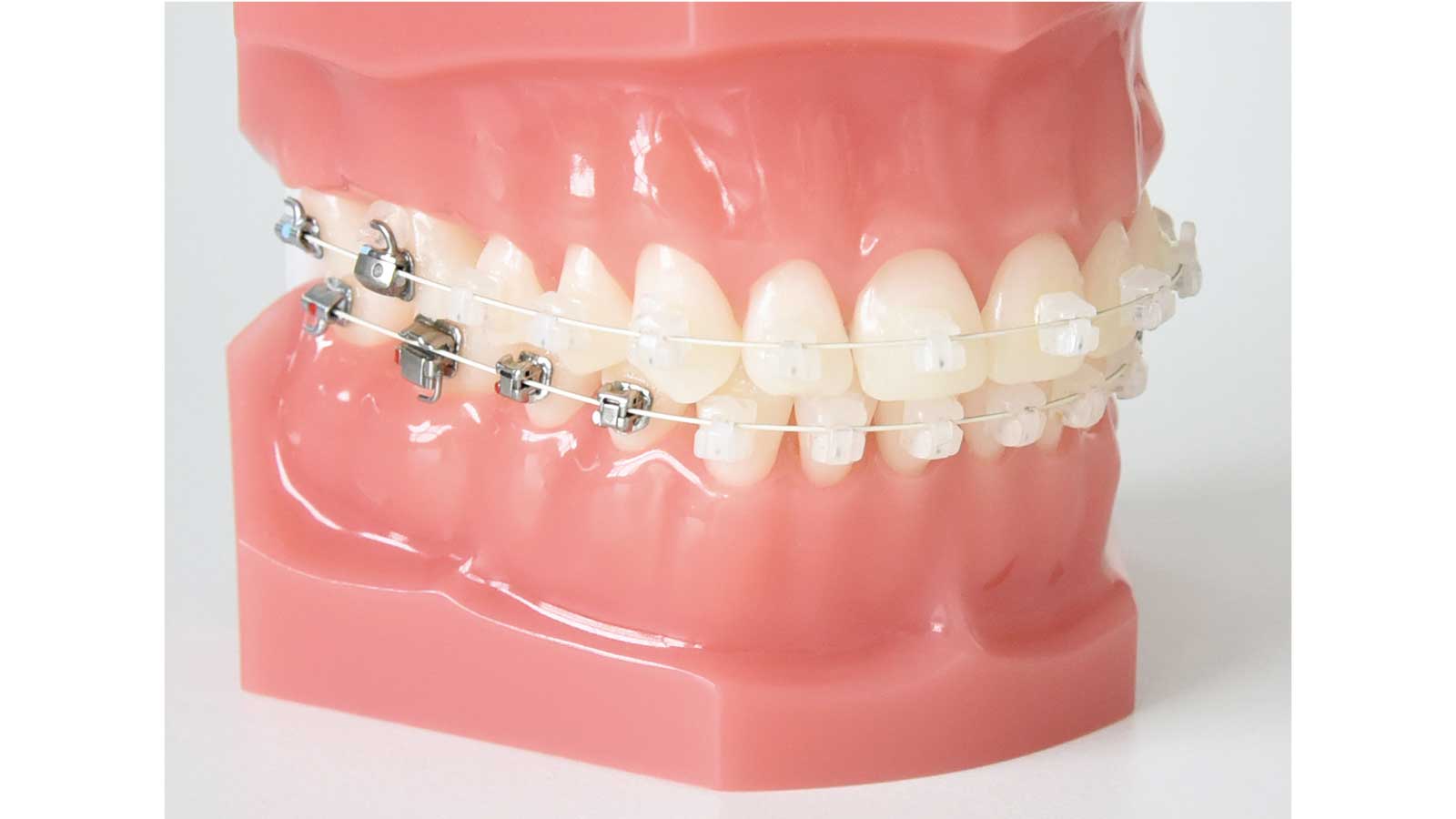 歯並びを直す方法 ワイヤー矯正
