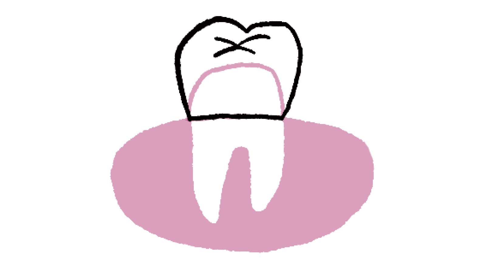 歯を失ったときの主な治療法 被せ物