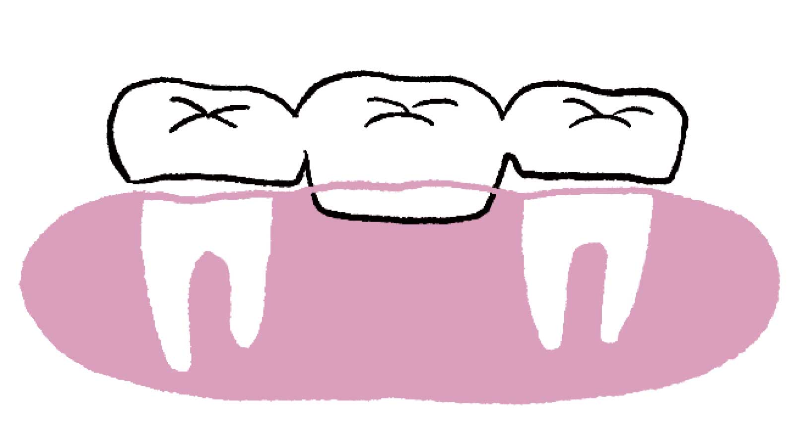 歯を失ったときの主な治療法　ブリッジ