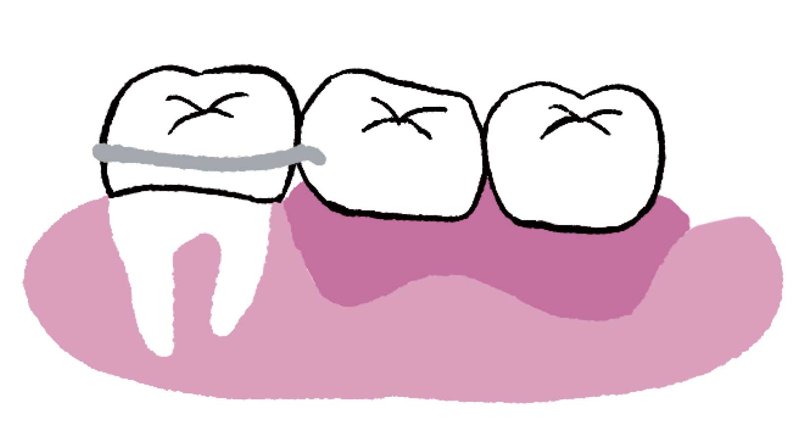 歯を失ったときの主な治療法　部分入れ歯