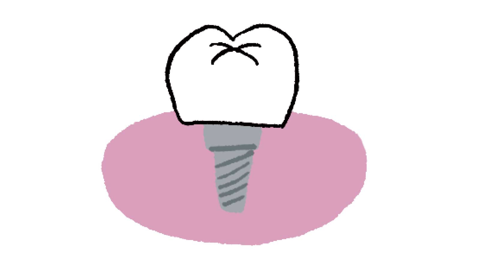 歯を失ったときの主な治療法　インプラント
