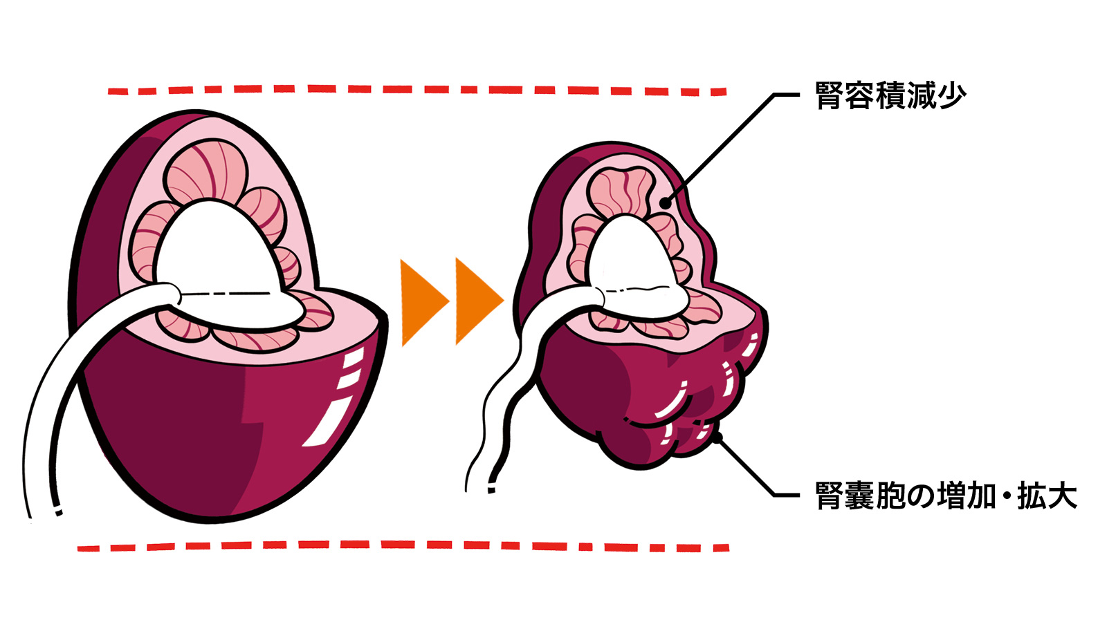 慢性腎臓病