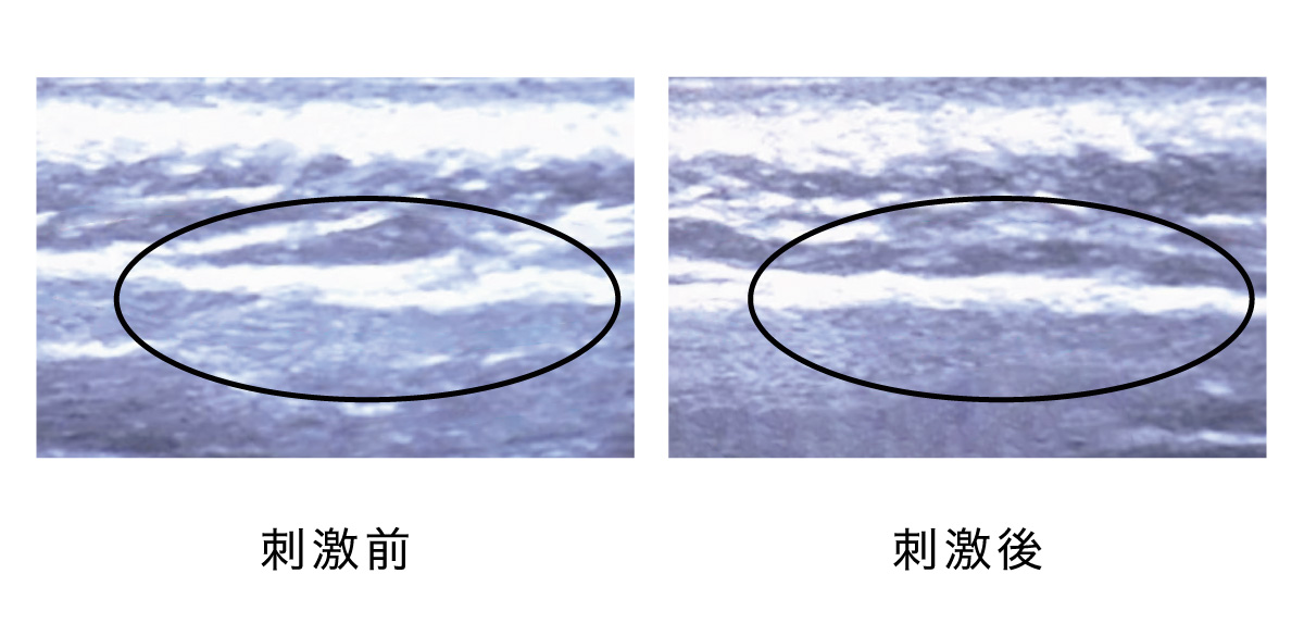 肩にある肩井を押した刺激による筋膜の違い