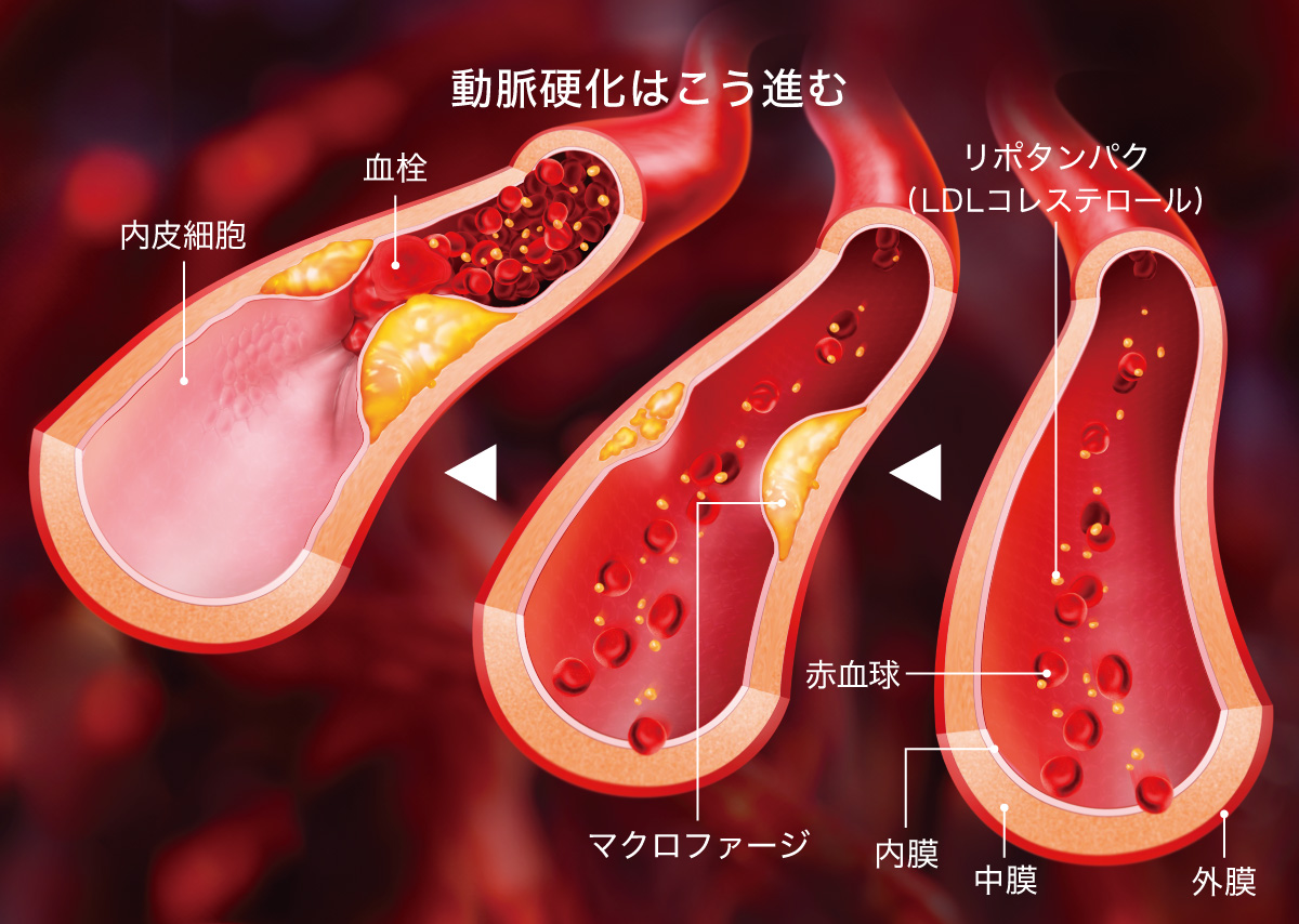 動脈硬化はこう進む