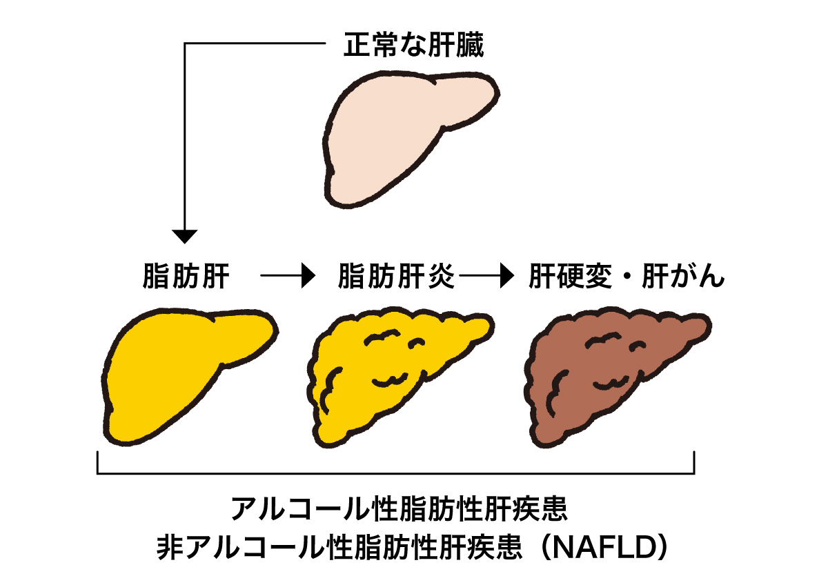非アルコール性脂肪肝の機序。