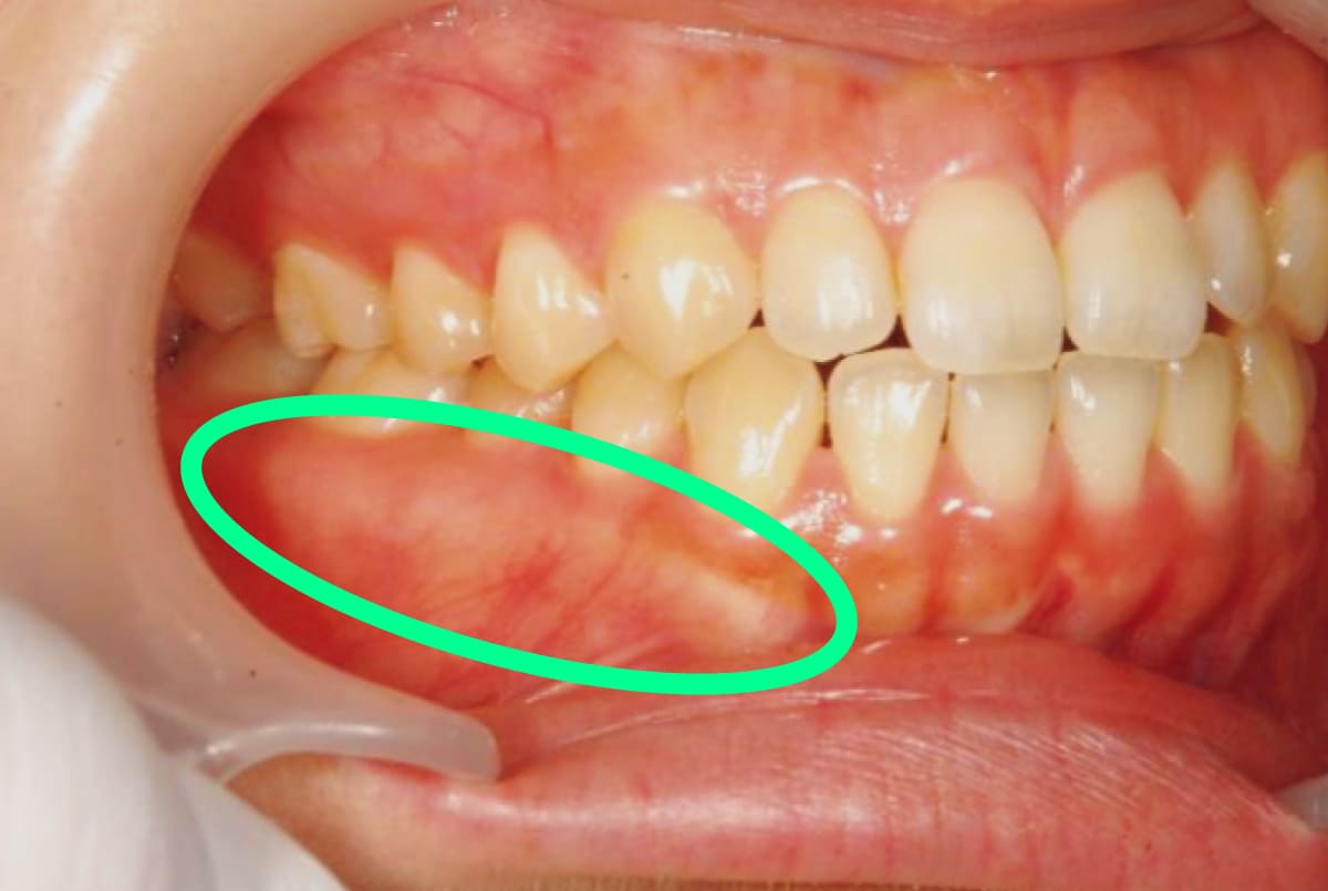 下顎の内側や外側の骨、上顎の中央部に骨が隆起する