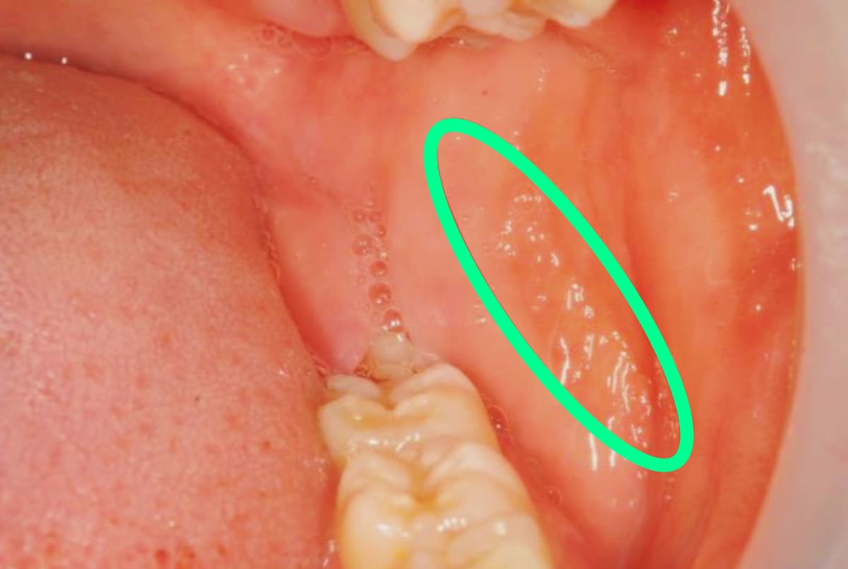 頰粘膜や舌につく圧痕