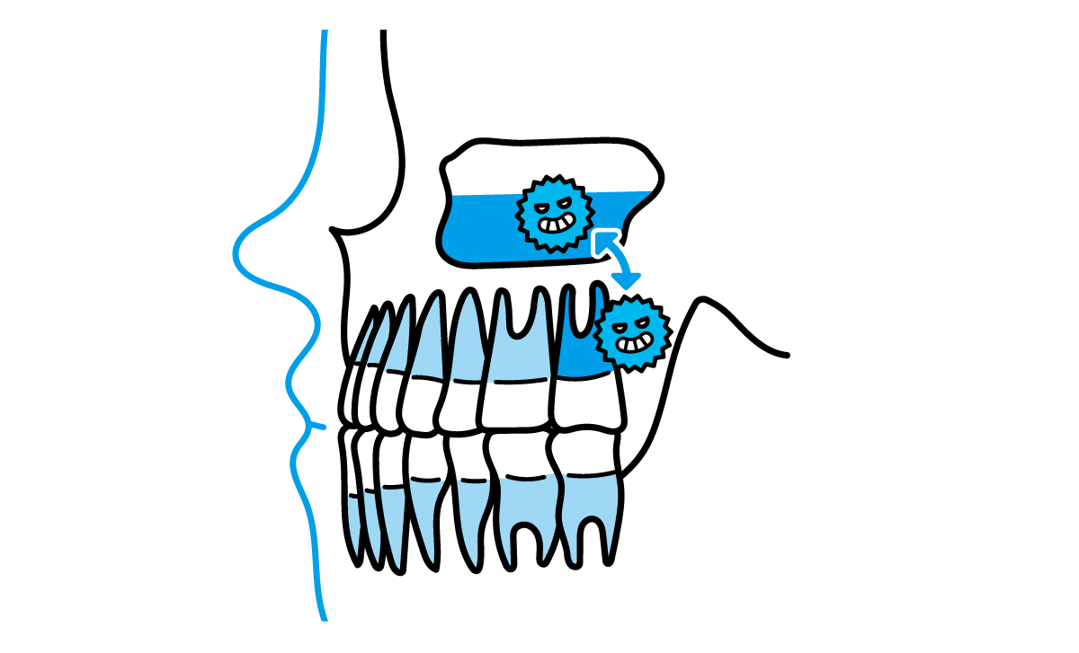 上顎洞性歯痛（じょうがくどうせいしつう）