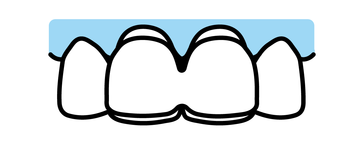 プラスチックのシーネの解説図