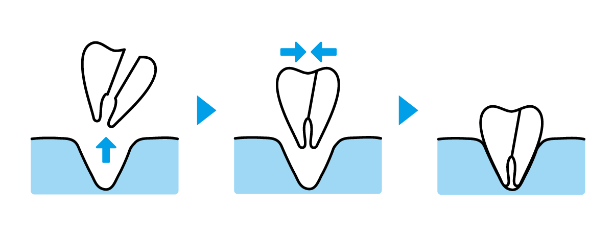 歯根破折の接着保存治療（＝再植法）