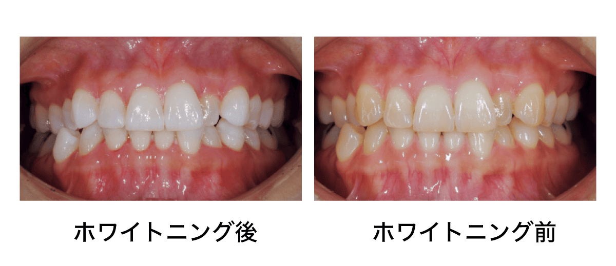 ホワイトニングのビフォーアフターの写真
