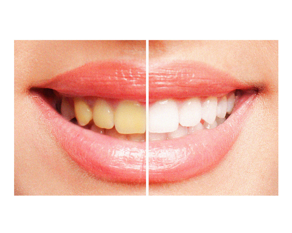 ホワイトニングで歯が白くなる理由。