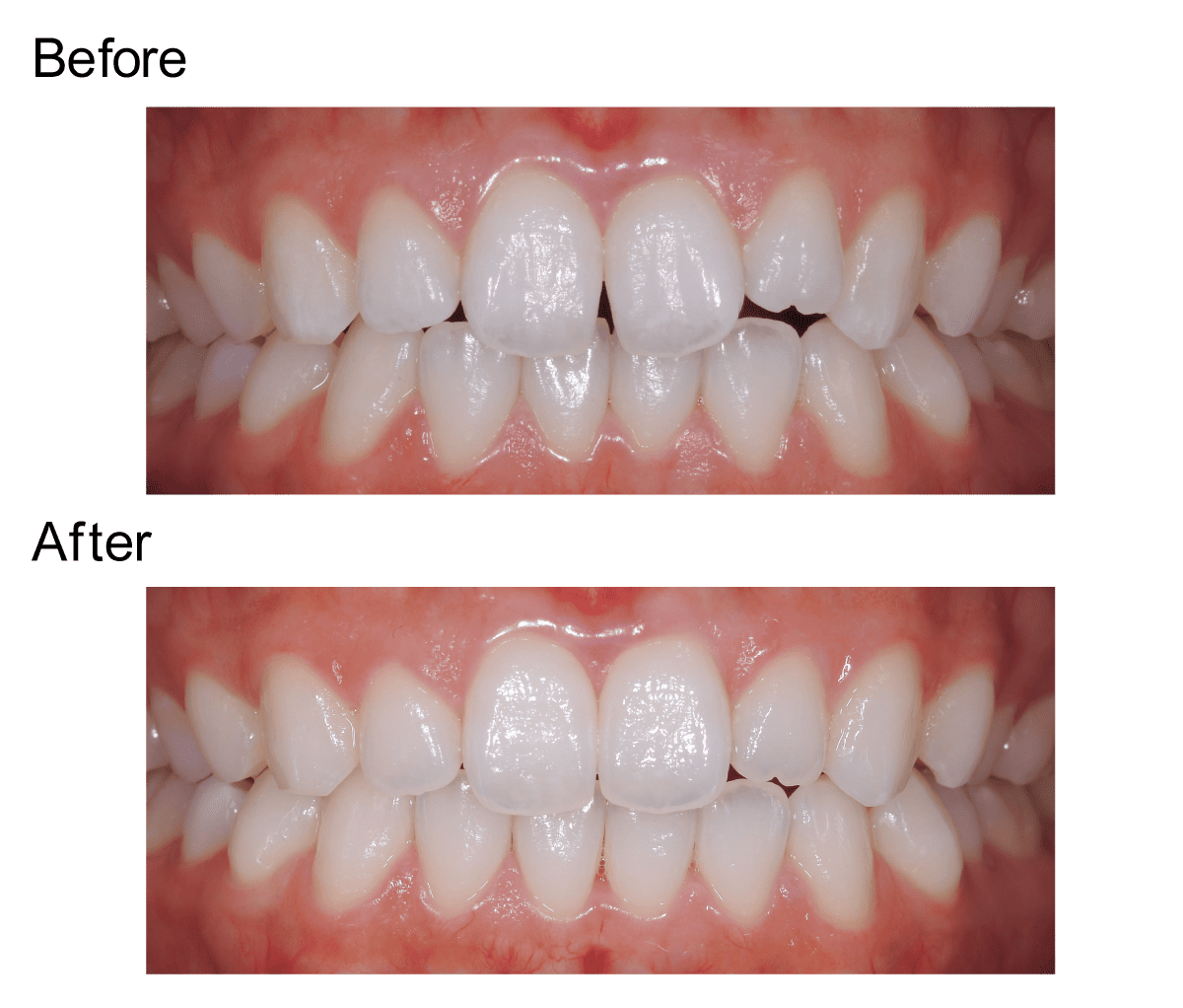 すきっ歯のビフォーアフター