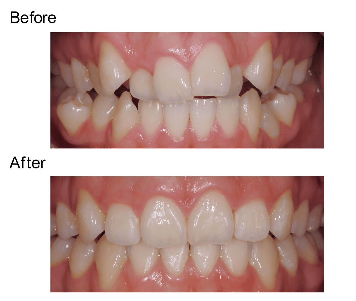 乱杭歯のビフォーアフター