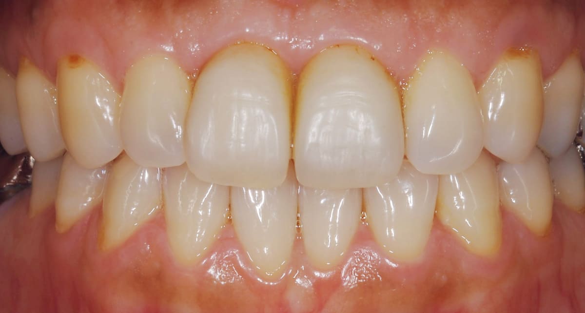 審美歯科_ジルコニア