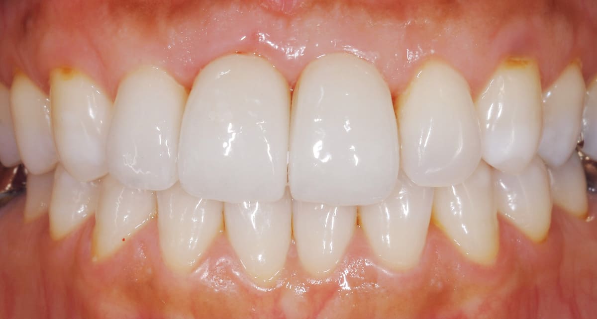 審美歯科_ジルコニア