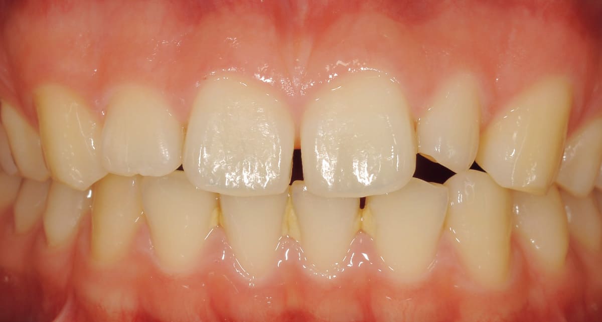 審美歯科_セラミック