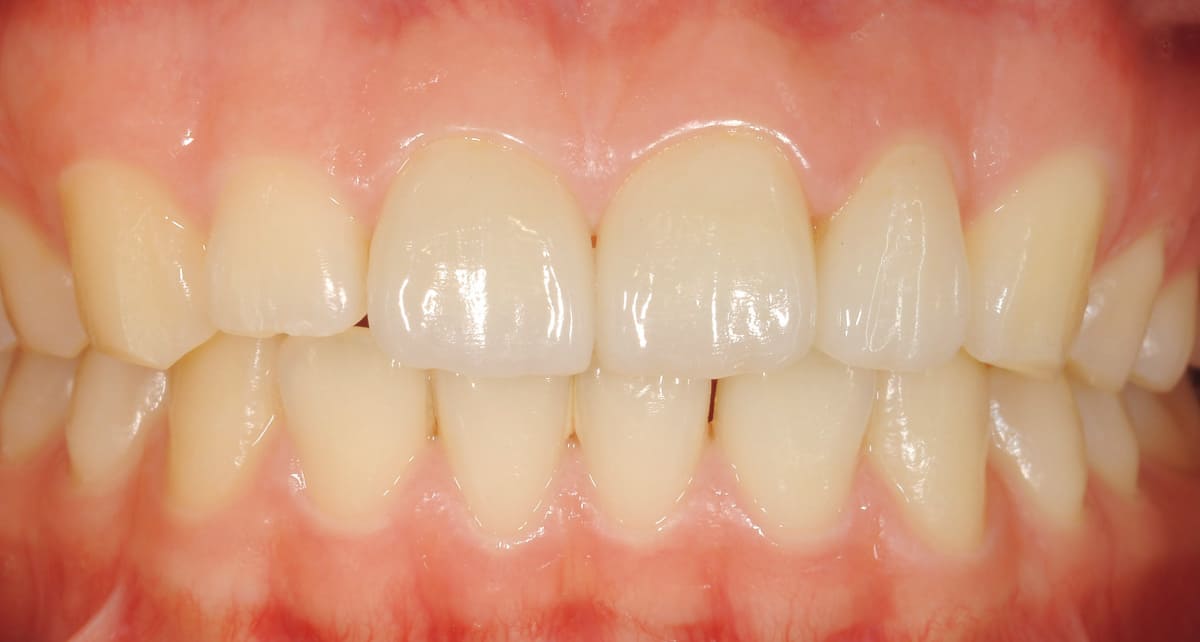 審美歯科_セラミック