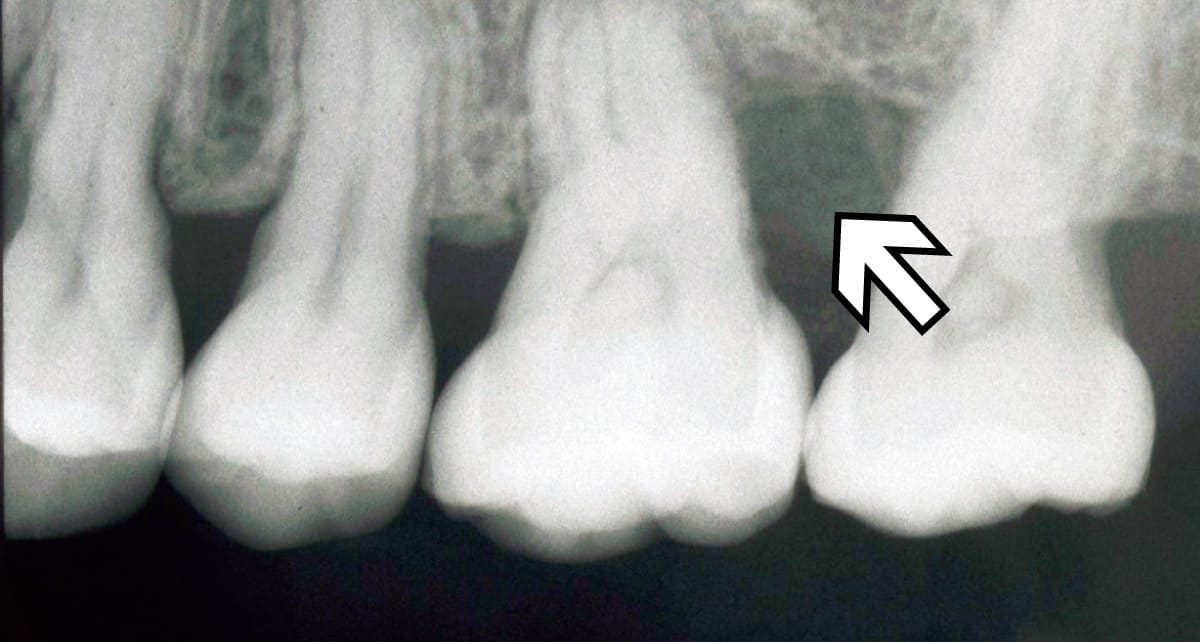 審美歯科_再生治療