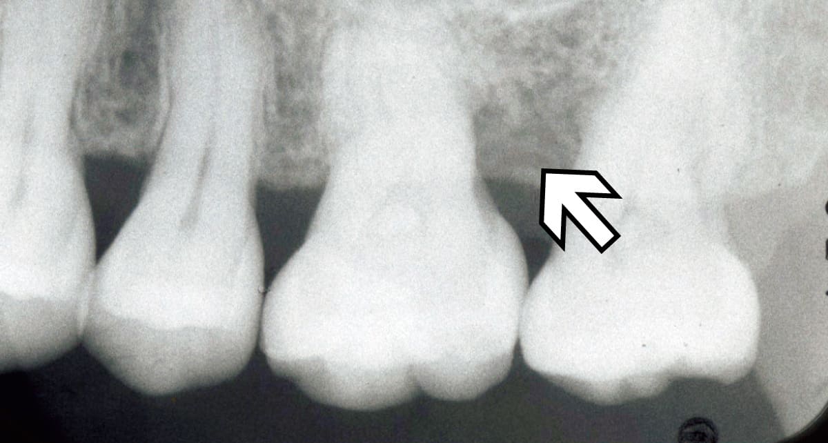 審美歯科_再生治療