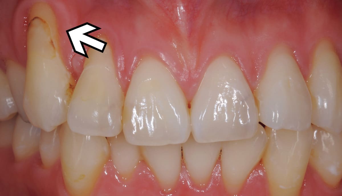 審美歯科_根面被覆