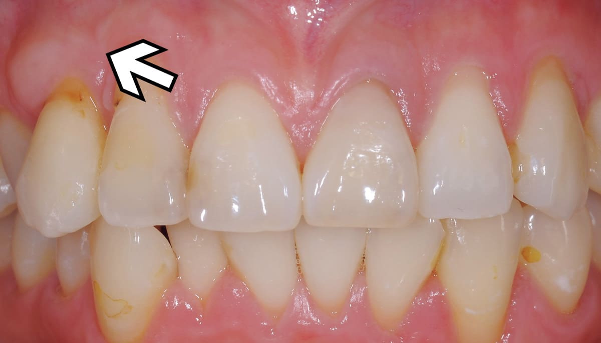 審美歯科_根面被覆