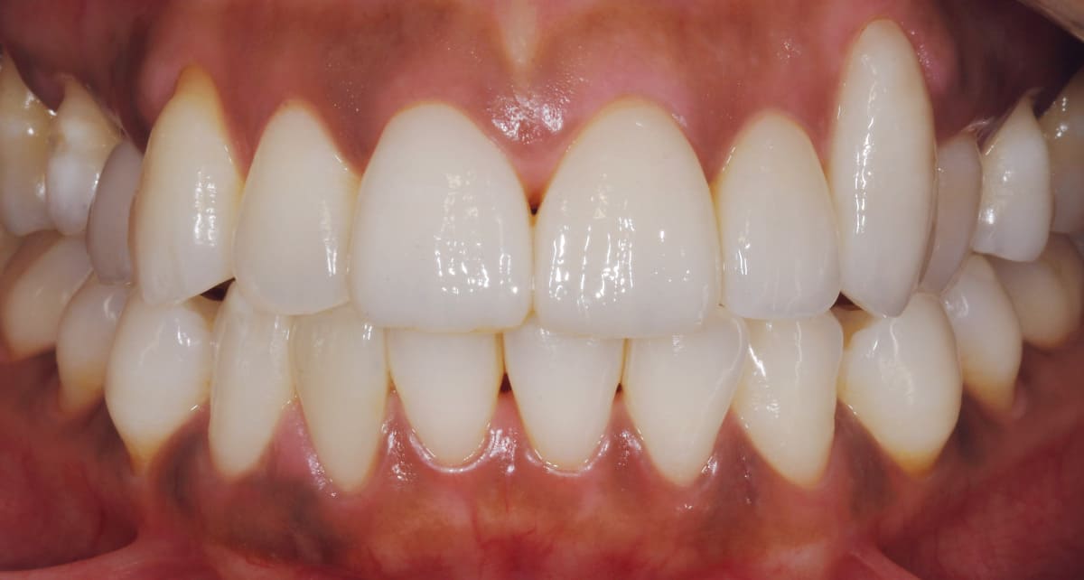 審美歯科_メラニン色素