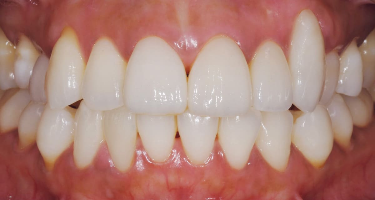 審美歯科_メラニン色素