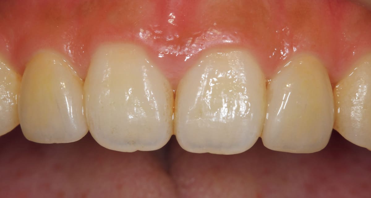 審美歯科_ラミネート