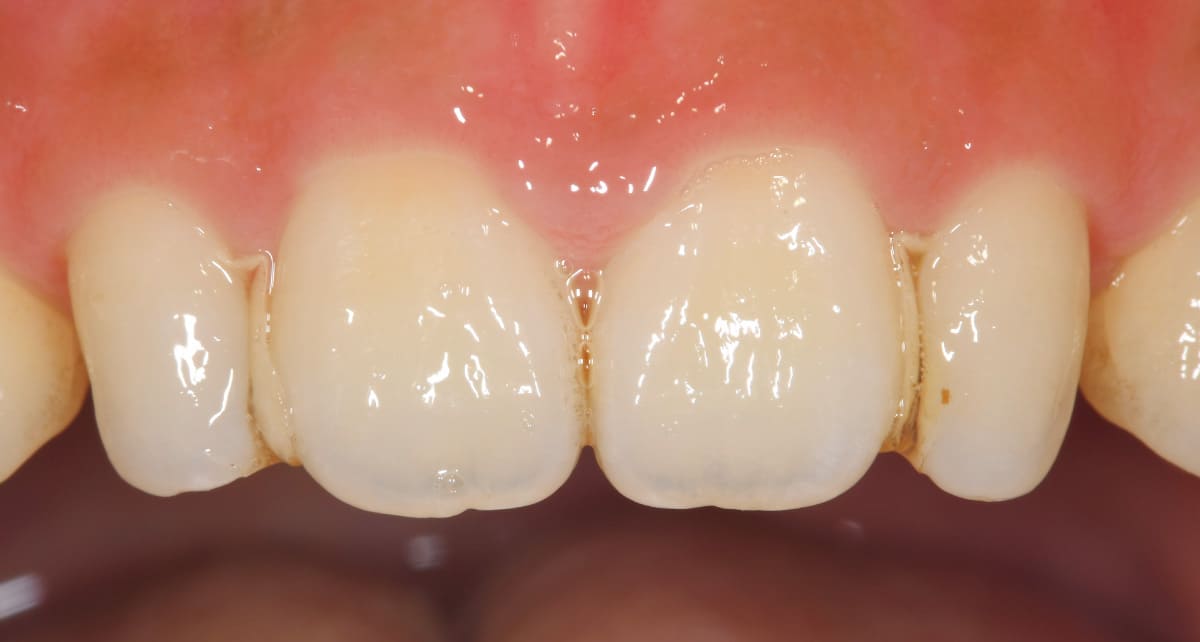 審美歯科_ラミネート