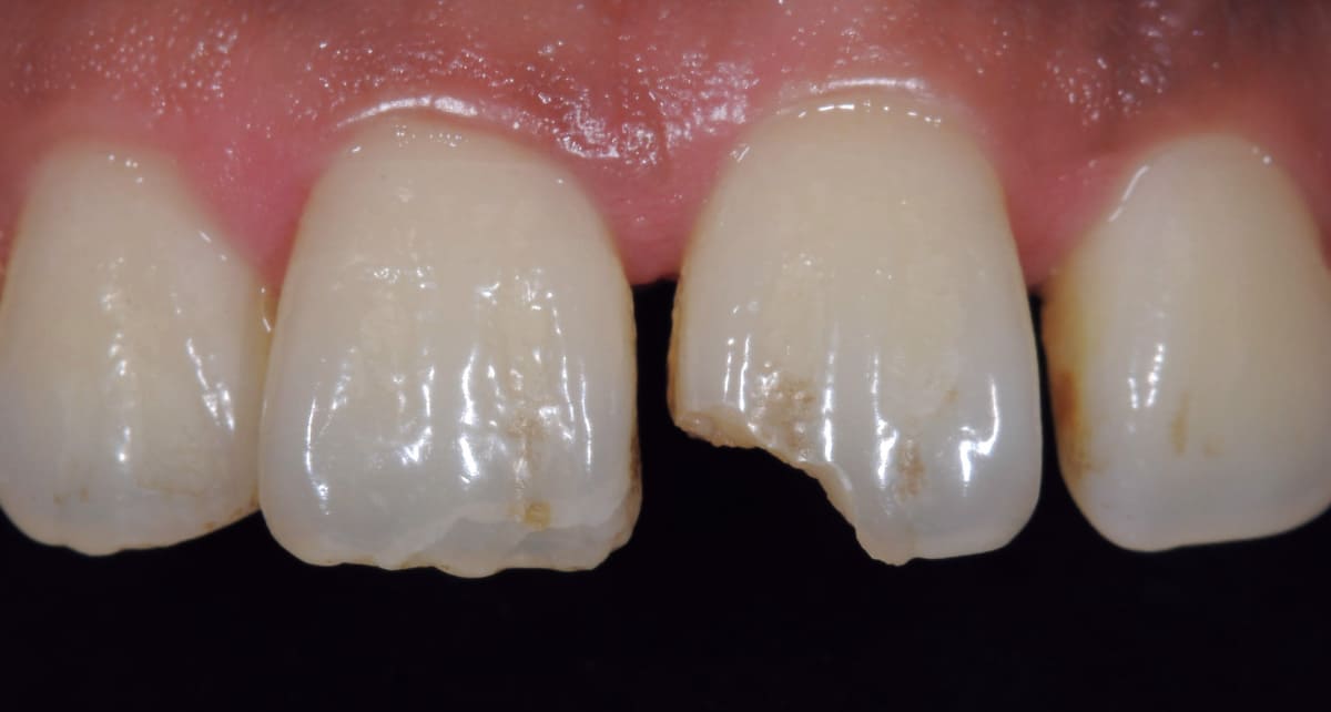 審美歯科_ダイレクトボンディング