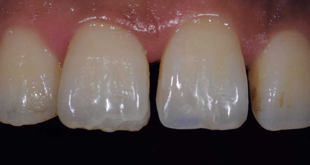 審美歯科_ダイレクトボンディング